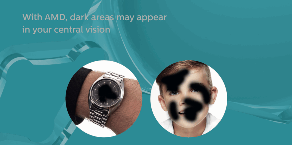 Schariot Macula Lens - visione dei pazienti maculopatici